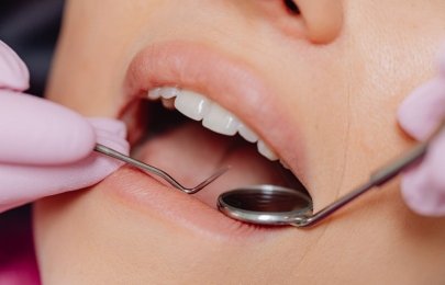 Tratamento de gengivite: guia prático e técnico para pacientes
